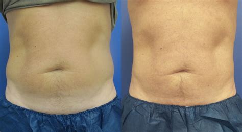 coolsculpting saudi arabia|Find a CoolSculpting Clinic : CoolSculpting® Middle East Region.